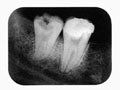 Películas de rayos X dentales